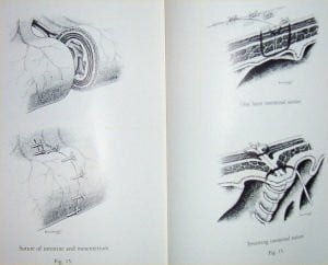 Sutures and Techniques for Wound Closure