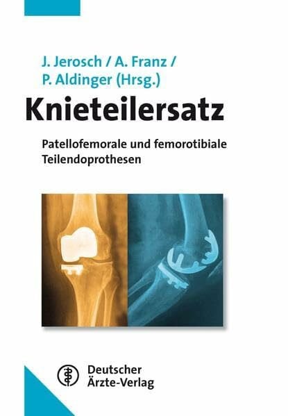 Aldinger, Peter Knieteilersatz: Patellofemorale und femorotibiale Teilendoprothesen
