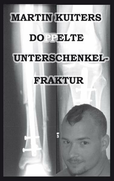 Martin Kuiters Doppelte Unterschenkelfraktur