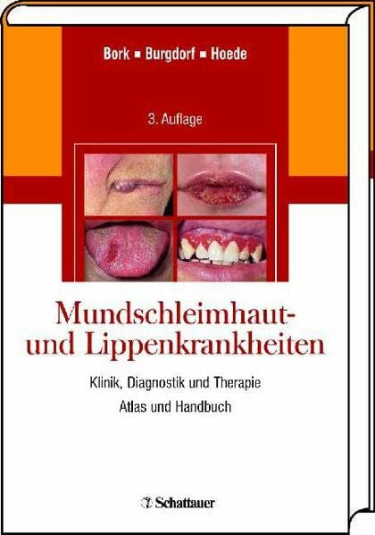 Hoede, Nikolaus Mundschleimhaut- und Lippenkrankheiten: Klinik, Diagnostik und Therapie Atlas und Handbuch