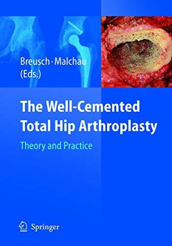 Malchau, Henrik The Well-Cemented Total Hip Arthroplasty: Theory and Practice