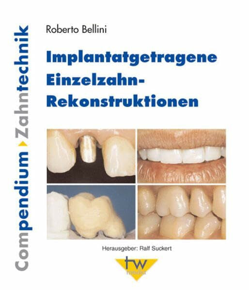 Roberto Bellini Implantatgetragene Einzelzahn-Rekonstruktionen