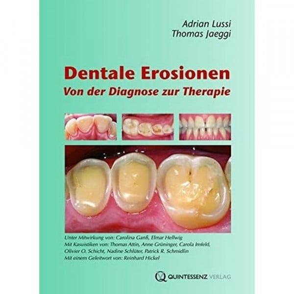 Adrian Lussi Dentale Erosionen: Von der Diagnose zur Therapie